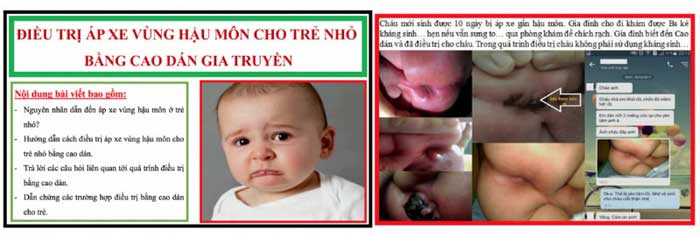 Điều trị áp xe hậu môn cho trẻ